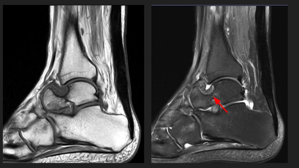 Figure 1 for case Charcot joint ( RID5075 )
